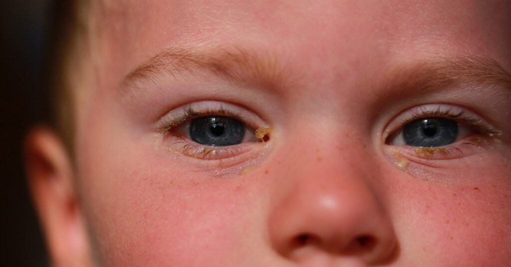 pink-eye-or-conjunctivitis-in-children-how-to-spot-treat-and-prevent